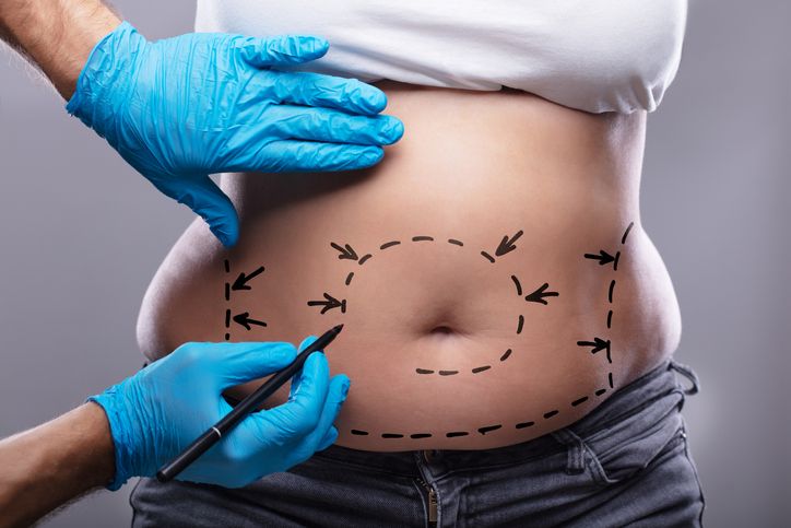 How to Maintain Your Liposuction Results for the Long Haul